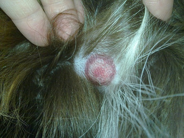 Tick bite with risk of Lyme disease tick bite with risk of Lyme disease